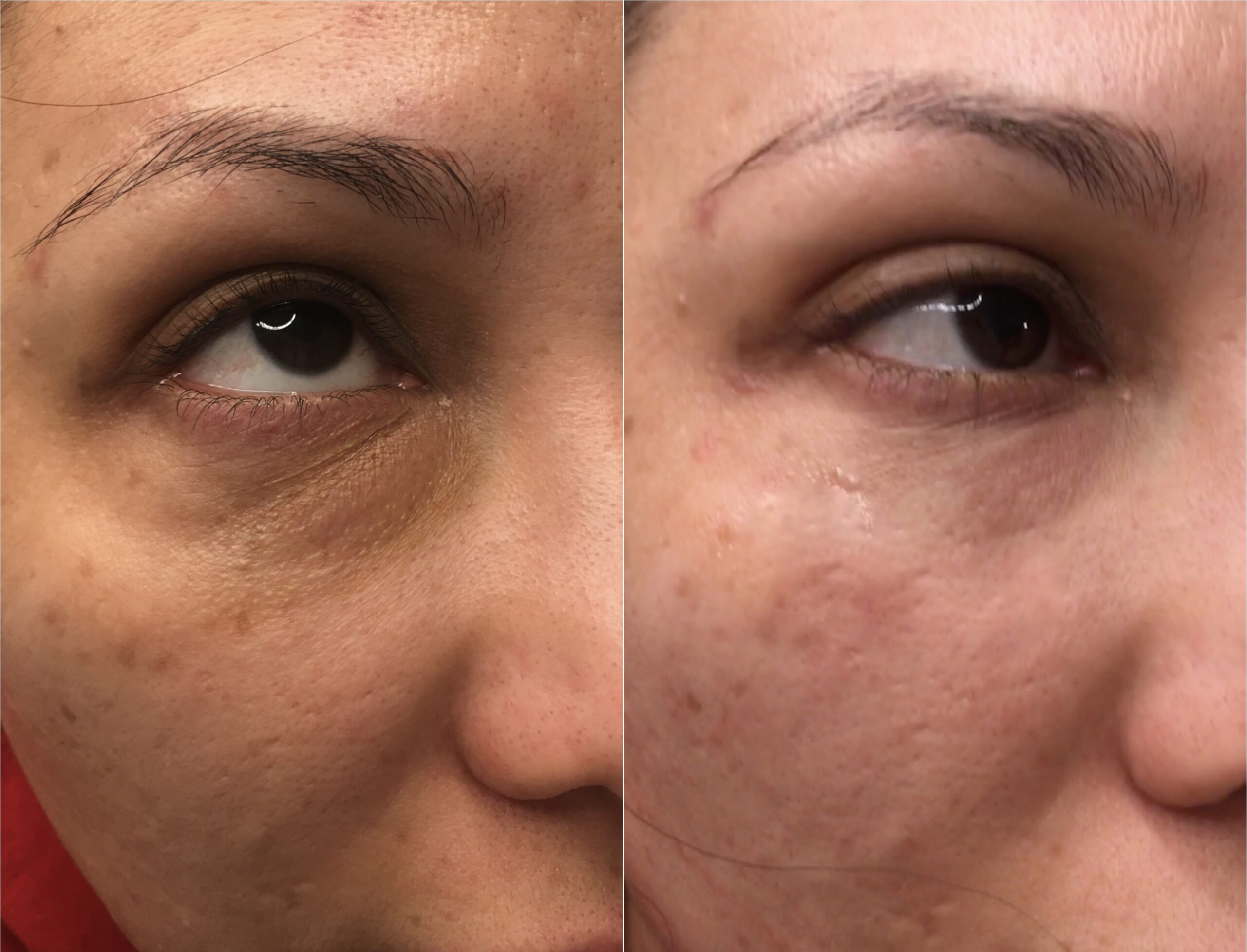 Skin before and After Dr. Mir Treatment