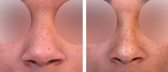 Best non surgical nose job in NYC