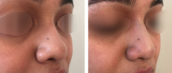 non-surgical rhinoplasty in New York