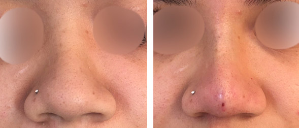 non-surgical rhinoplasty in New York