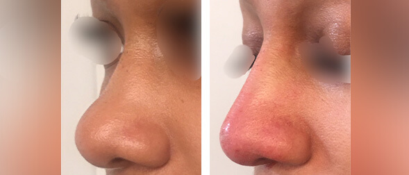 Best non surgical nose job in NYC