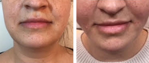 Non Surgical Facelift before and After