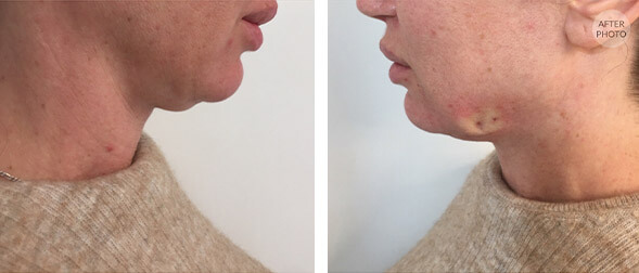 Non Surgical Facelift before and After